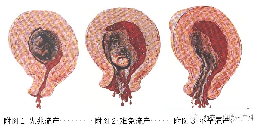 最新进的流产技术，探索与理解